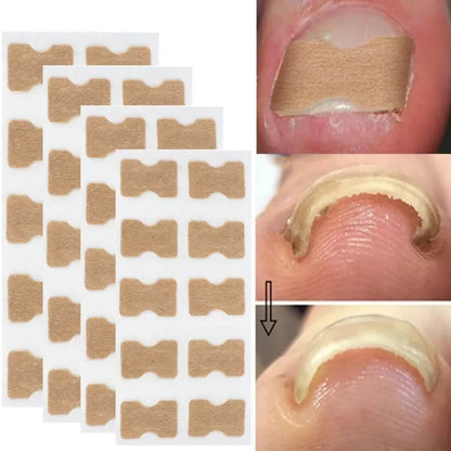 Jaysuing Paronychia Relief Patch