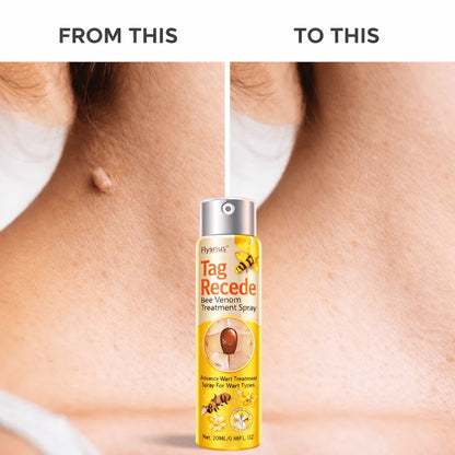 Wart Remover Spray – Fast & Easy At-Home |Bee Venom Skin Tag Remover Spray