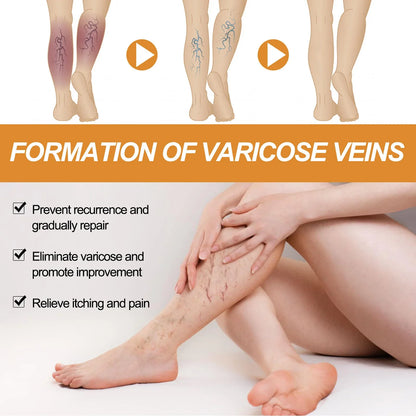 Turmeric Varicose Vein Relief