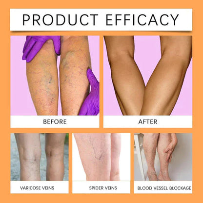 Turmeric Varicose Vein Relief