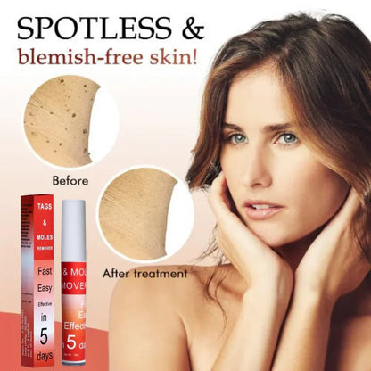 LOVILDS™ Tags & Moles Remover